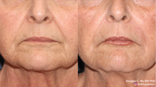 Softening of folds and wrinkles to lips and around mouth with filler.