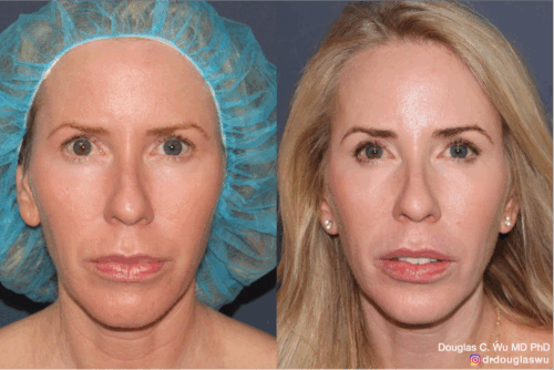 Customized maintenance treatment plan-10 years later