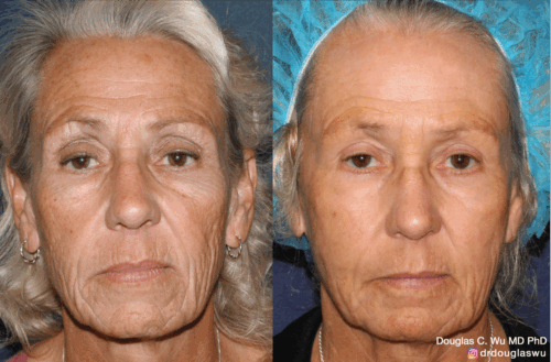 Customized maintenance treatment plan -10 years later