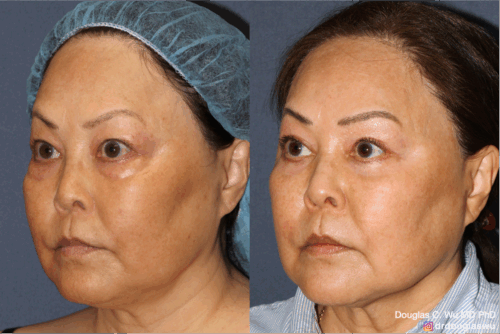 Customized maintenance treatment plan -10 years later