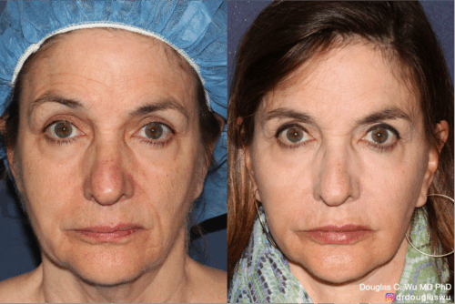 Customized maintenance treatment plan-5 years later