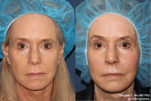 Customized maintenance treatment plan-10 years later