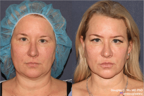 multimodal combination treatment-pico-vbeam-IPL-CO2-thermi-BTX-filler