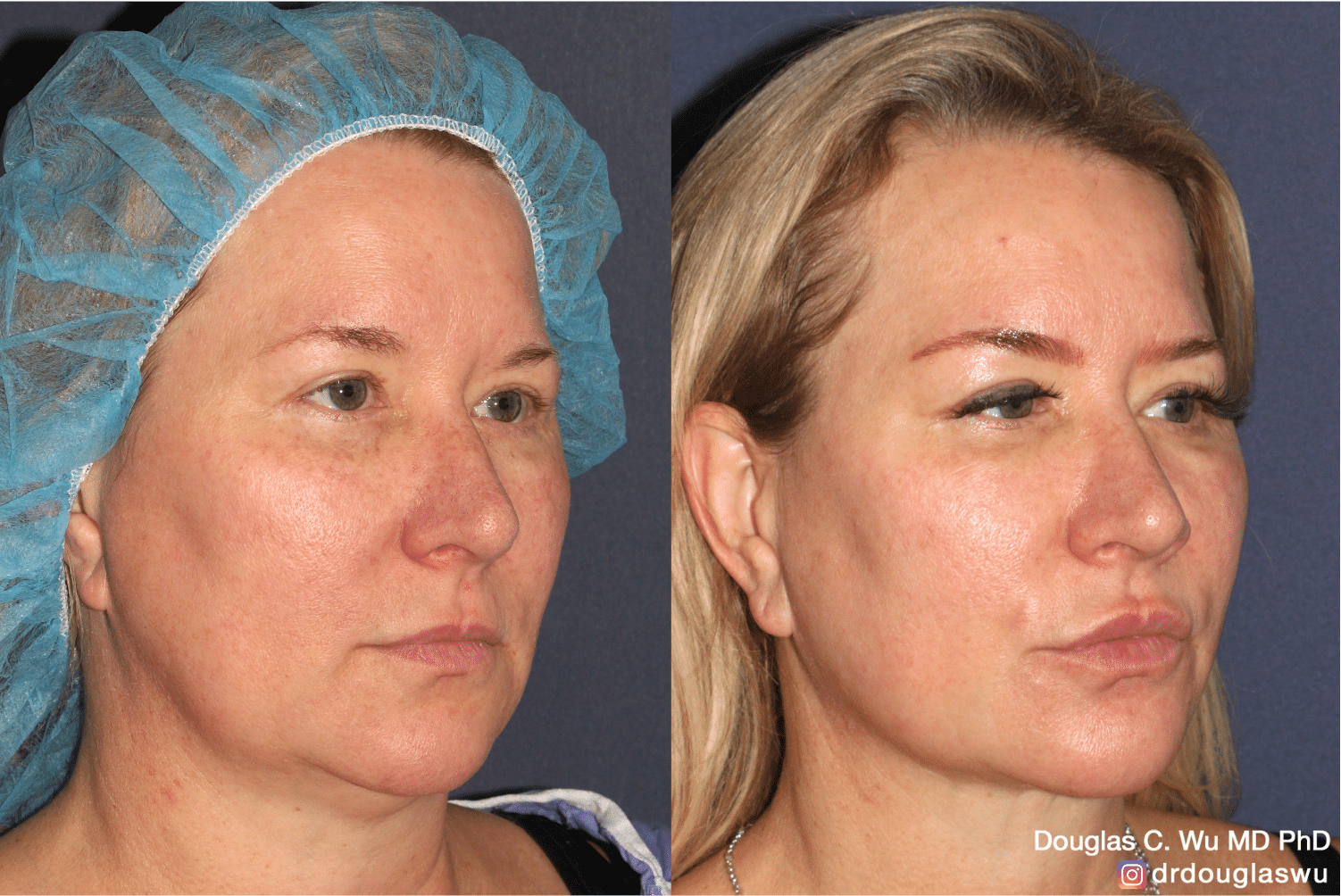 IPL Treatment Before and After photos