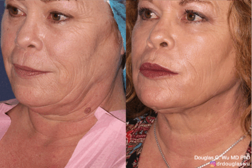 multimodal combination treatment-co2-pico-vbeam-thermi-btx-filler