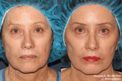 Multimodal combination treatment-co2-eryag-pico-vbeam-ulthera-btx-filler