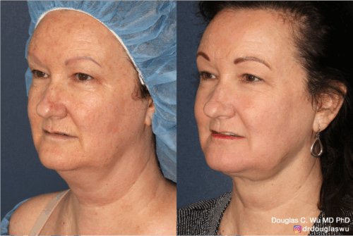 Multimodal combination treatment-co2-pico-vbeam-thermi-btx
