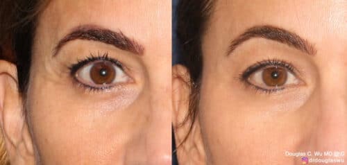 Botox for lateral canthal lines (“crow’s feet”)