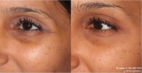 Botox for lateral canthal lines (“crow’s feet”)