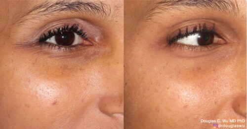 Botox for lateral canthal lines (“crow’s feet”)