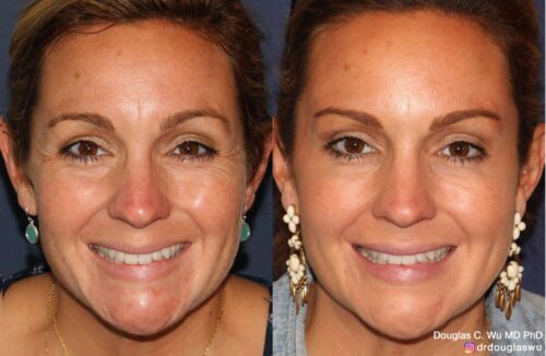 Botox for lateral canthal lines (“crow’s feet”)