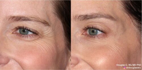 Botox for lateral canthal lines (“crow’s feet”)