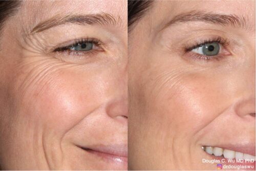 Botox for lateral canthal lines (“crow’s feet”)