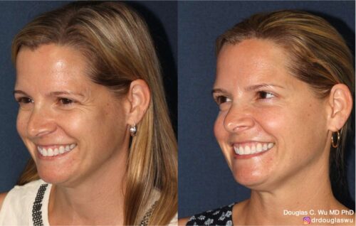 Botox for lateral canthal lines (“crow’s feet”)