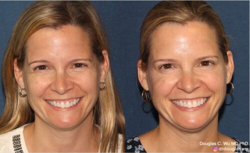 Botox for lateral canthal lines (“crow’s feet”)