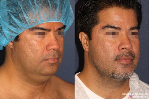 ThermiSculpt to neck and jawline