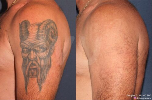 Tattoo removal