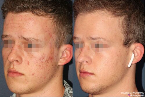 Acne and acne scar treatment