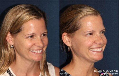 Botox for lateral canthal lines (“crow’s feet”)
