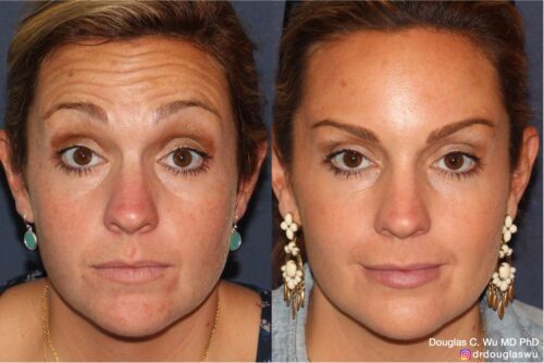 Botox for forehead winkles