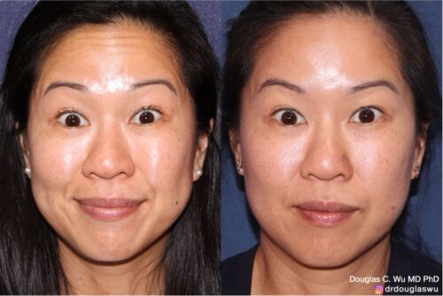 Botox for forehead winkles