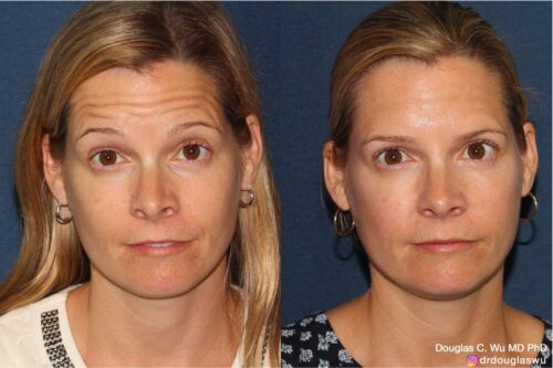 Botox for forehead winkles