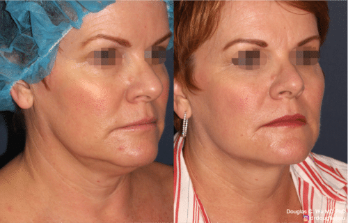 ThermiSculpt to tighten and refine the neck and jawline
