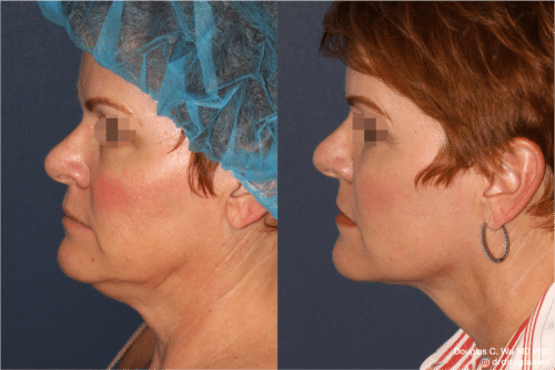 ThermiSculpt to tighten and refine the neck and jawline