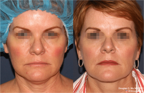 ThermiSculpt to tighten and refine the neck and jawline