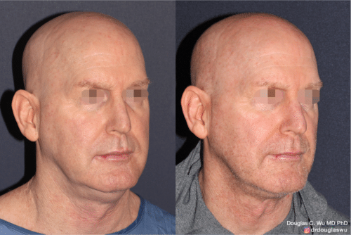 ThermiSculpt to tighten and refine the neck and jawline