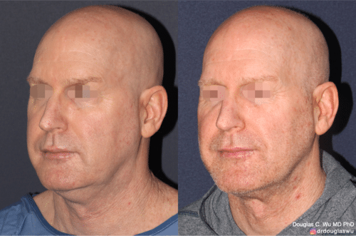 ThermiSculpt to tighten and refine the neck and jawline