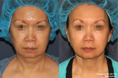 ThermiSculpt to tighten and refine the neck and jawline