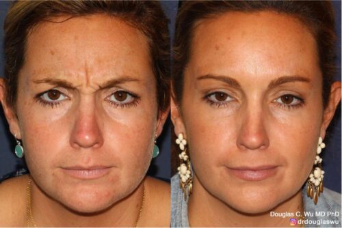 Botox for frown lines