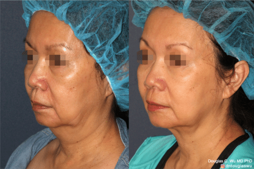 ThermiSculpt to tighten and refine the neck and jawline