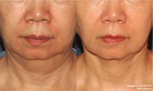 ThermiSculpt to tighten and refine the neck and jawline