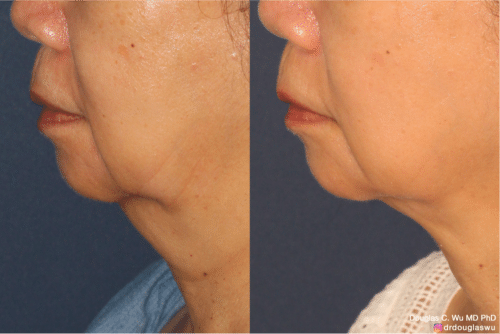 ThermiSculpt to tighten and refine the neck and jawline