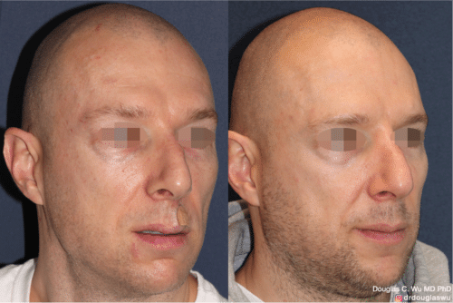 Laser resurfacing is one of the most effective ways to tighten the skin, remove wrinkling and fine lines that give a dull tired appearance.