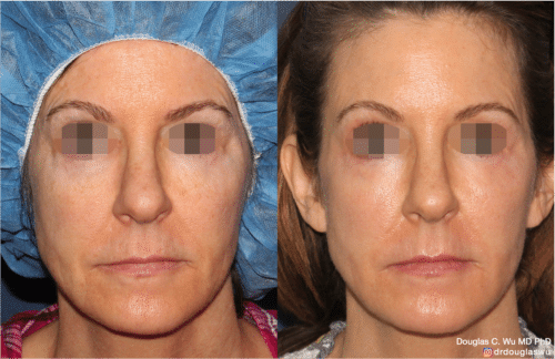 Laser resurfacing is one of the most effective ways to tighten the skin, remove wrinkling and fine lines that give a dull tired appearance.