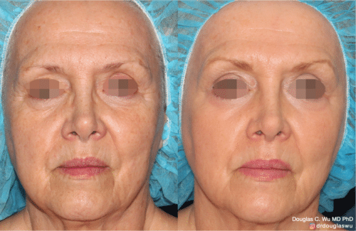 Laser resurfacing is one of the most effective ways to tighten the skin, remove wrinkling and fine lines that give a dull tired appearance.