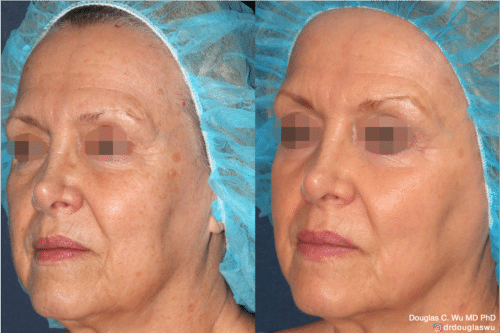 Laser resurfacing is one of the most effective ways to tighten the skin, remove wrinkling and fine lines that give a dull tired appearance.