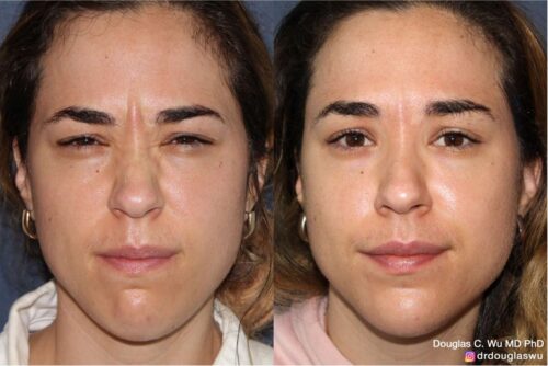 Botox for frown lines