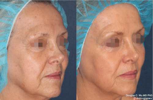 Laser resurfacing is one of the most effective ways to tighten the skin, remove wrinkling and fine lines that give a dull tired appearance.