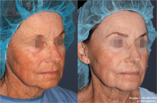 Laser resurfacing is one of the most effective ways to tighten the skin, remove wrinkling and fine lines that give a dull tired appearance.