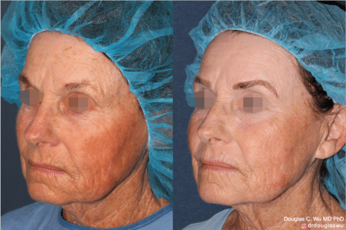 Laser resurfacing is one of the most effective ways to tighten the skin, remove wrinkling and fine lines that give a dull tired appearance.