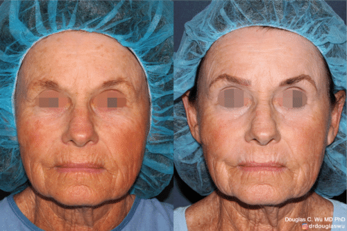 Laser resurfacing is one of the most effective ways to tighten the skin, remove wrinkling and fine lines that give a dull tired appearance.