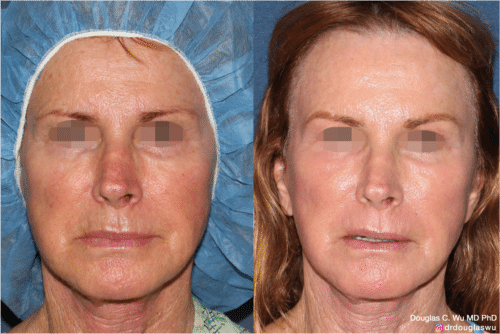 Laser resurfacing is one of the most effective ways to tighten the skin, remove wrinkling and fine lines that give a dull tired appearance.