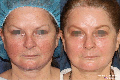 Laser resurfacing is one of the most effective ways to tighten the skin, remove wrinkling and fine lines that give a dull tired appearance.