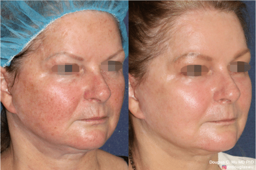 Laser resurfacing is one of the most effective ways to tighten the skin, remove wrinkling and fine lines that give a dull tired appearance.