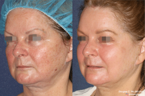 Laser resurfacing is one of the most effective ways to tighten the skin, remove wrinkling and fine lines that give a dull tired appearance.