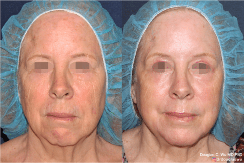 Laser resurfacing is one of the most effective ways to tighten the skin, remove wrinkling and fine lines that give a dull tired appearance.